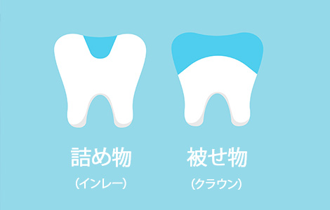 被せ物・詰め物の違い