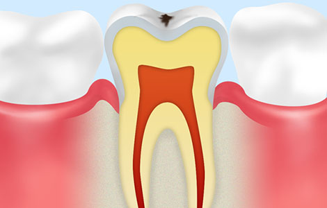 表面の虫歯の場合