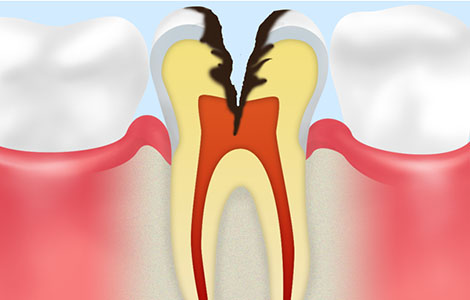 虫歯が神経まで達している場合