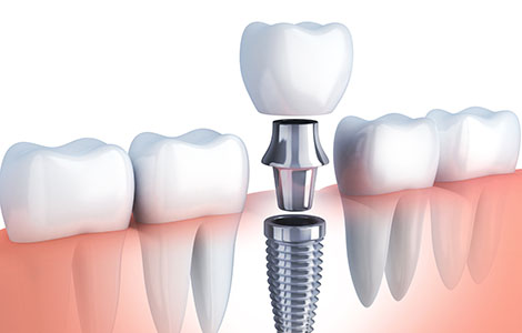 歯周病とインプラントの関係