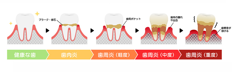 歯周病治療の進行