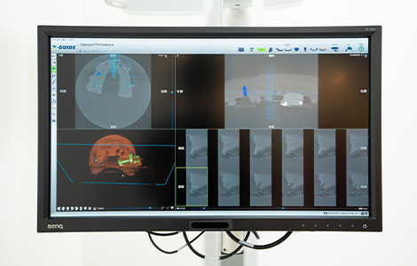 特徴1：リアルタイム3Dガイダンスにより治療精度が向上