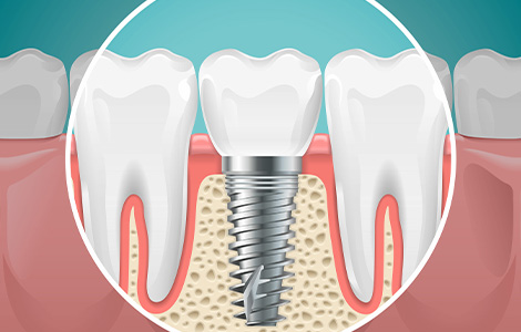 02：抜歯と同時にインプラントを入れる「抜歯即時埋入」