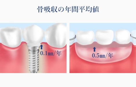 歯を支える骨の吸収を抑えられる