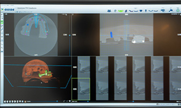 シュミレーションアプリにてインプラント埋入プランニング